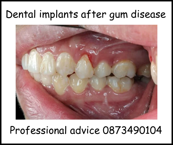 Dental implants after gum disease image 