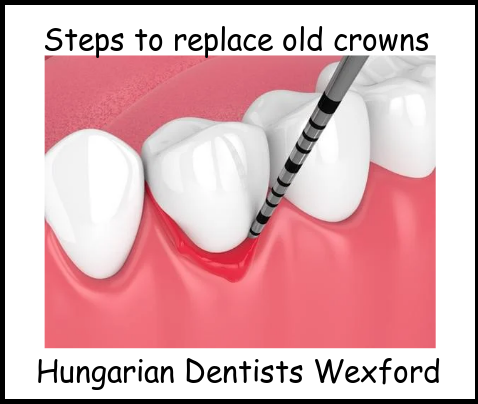 Steps to replace old crowns image