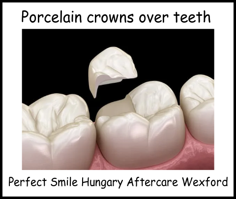 Porcelain crowns over teeth image