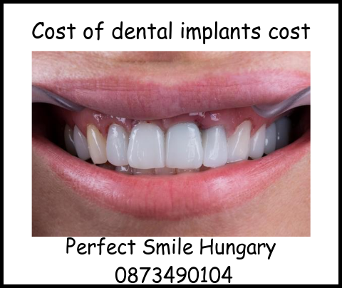 Cost of dental implants cost Perfect Smile dental image