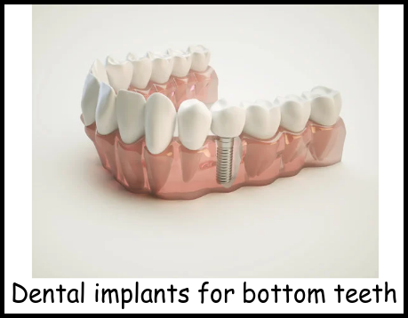 Dental implants for bottom teeth image