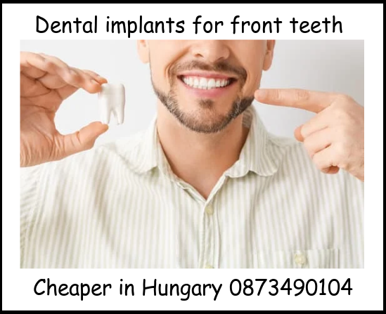 Dental implants for front teeth image