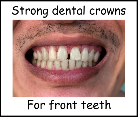 Strong dental crowns for front teeth image