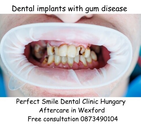 Dental implants with gum disease image