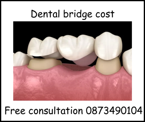 Dental bridge cost image