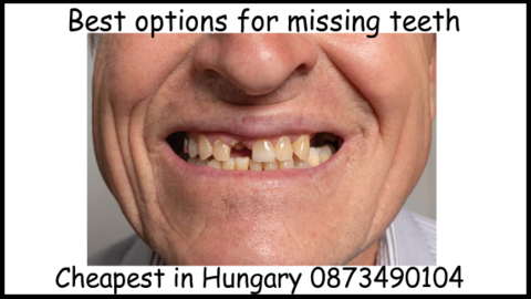 Best options for missing teeth image