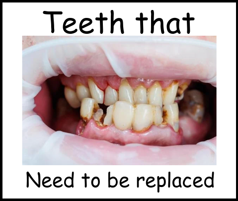 Teeth that need to be replaced image