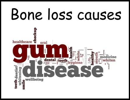 Bone loss causes image