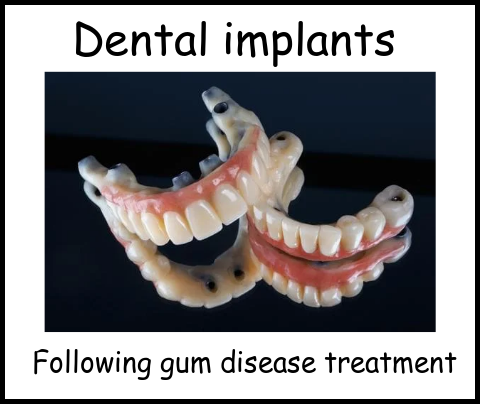 Dental implants following gum disease treatment image