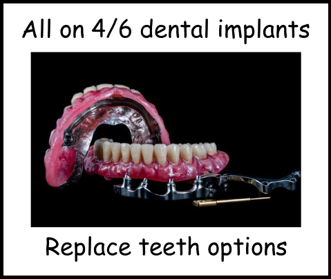 All on 4/6 dental implants replace teeth options image