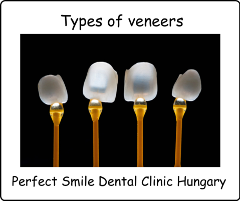 Types of veneers image