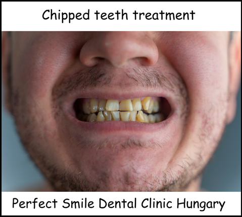 Chipped teeth treatment image 