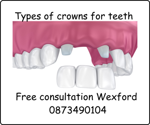 Types of crowns for teeth image