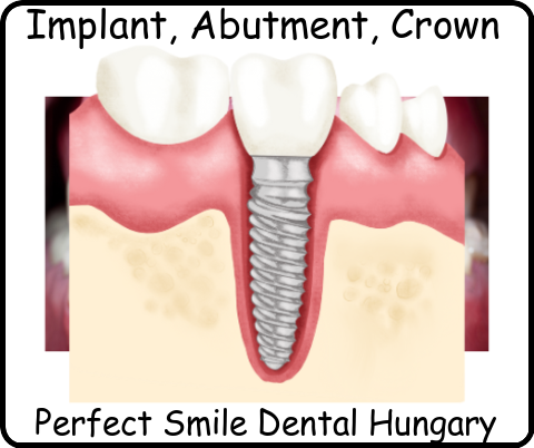 Implant abutment crown image