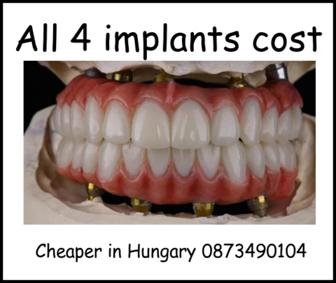 All 4 dental implants cost image