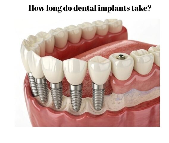 How long do dental implants take image