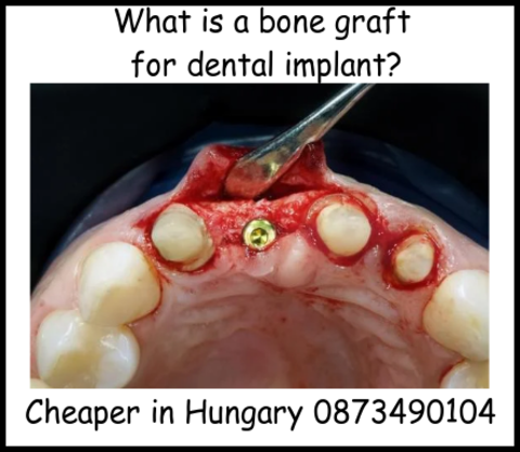 What is a bone graft for dental implant image