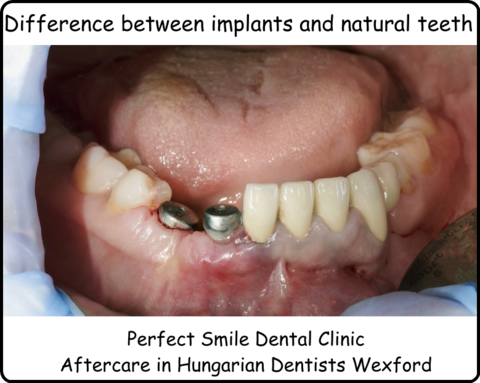 Difference between full mouth implants and natural teeth image