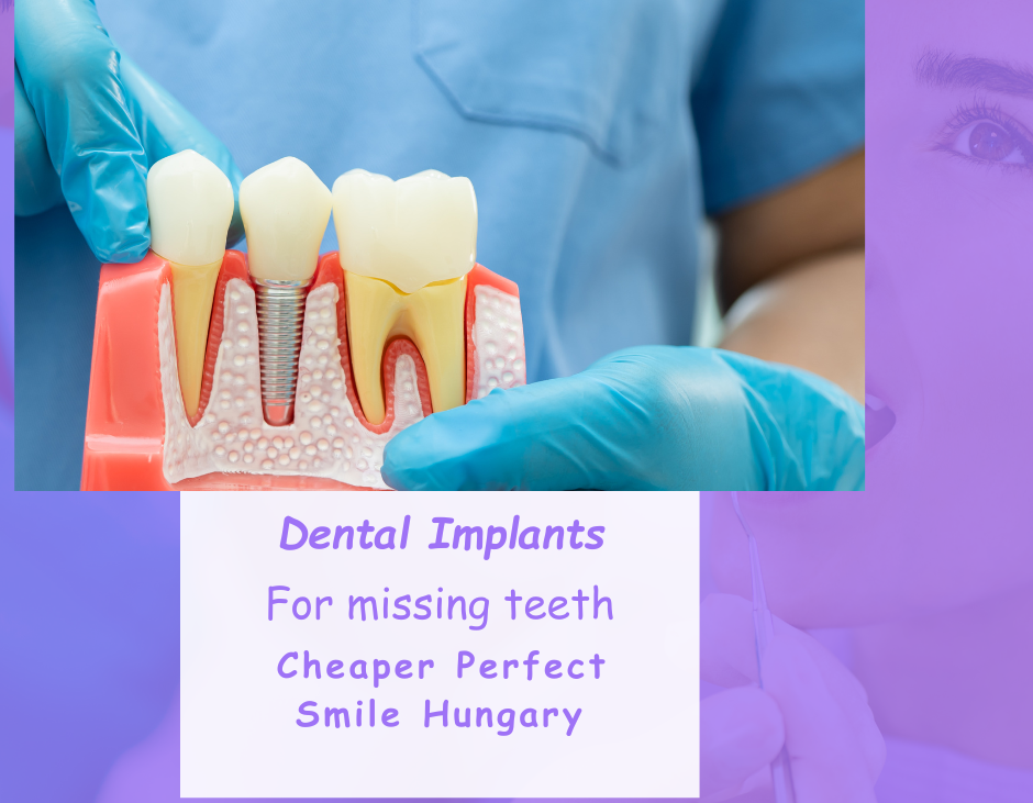 Dental implants for missing teeth cheaper Perfect Smile dental clinic Hungary image