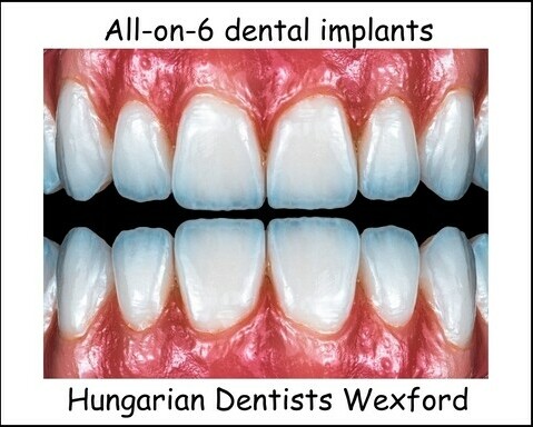 All-on-6 dental implants image