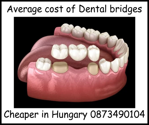 Average cost of dental bridges image