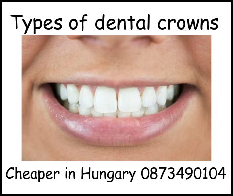 Types of dental crowns image