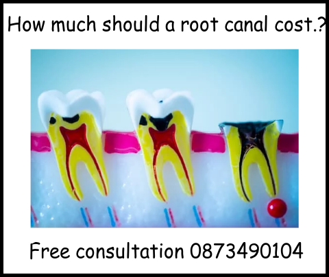 How much should a root canal cost image