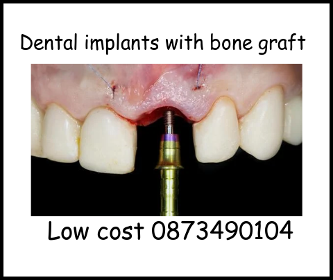 Dental implants with bone graft image