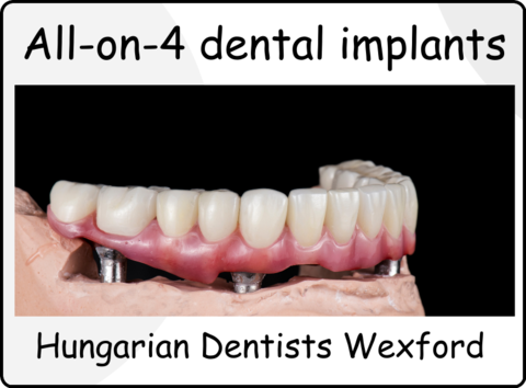 All-on-4 dental implants image