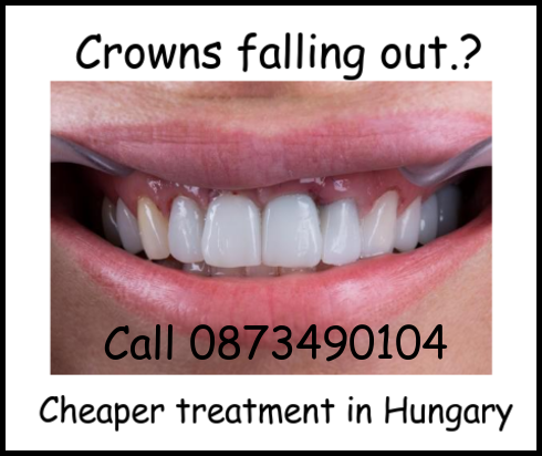 Crowns falling out image 