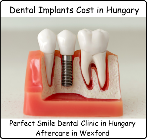 Dental implants cost in Hungary image