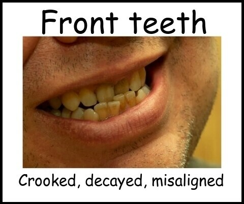 Front teeth image