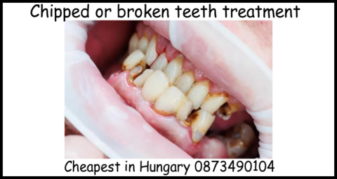 Chipped or broken teeth treatment cheapest in Hungary image