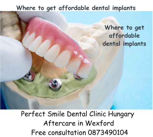 Where to get affordable dental implants image