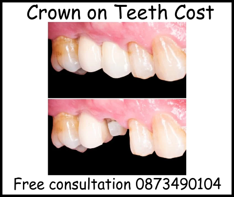 Crown on teeth cost image