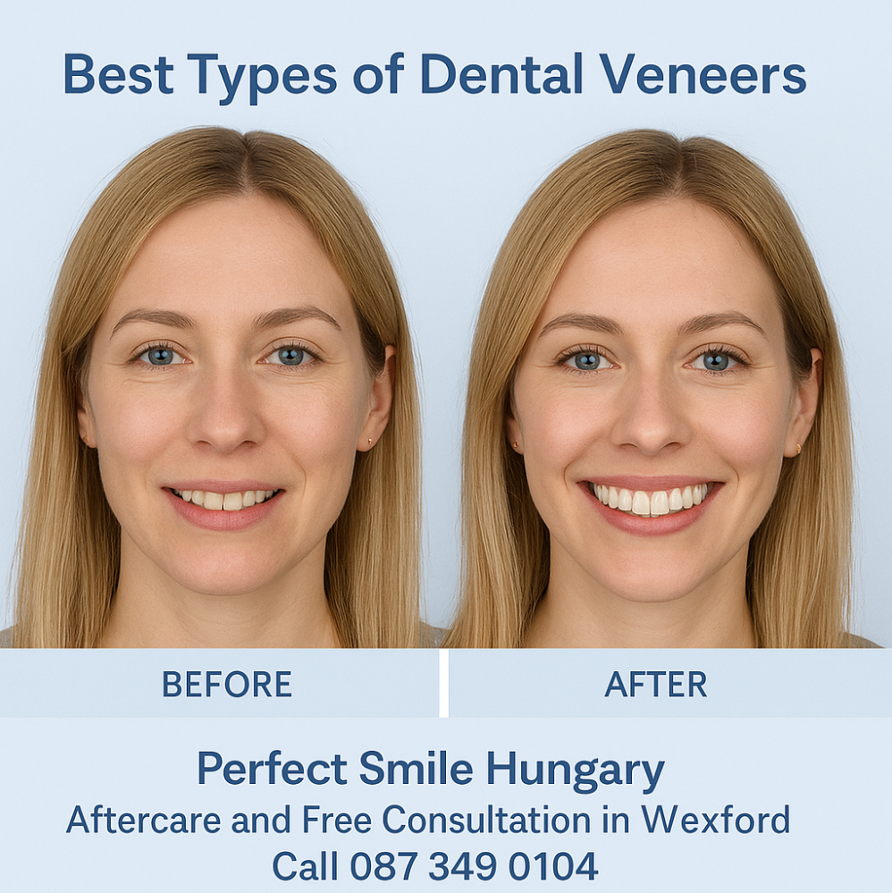 Before and after dental veeners treatment in Perfect Smile dental clinic Hungary image