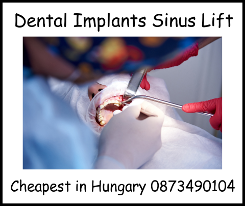 Dental implants sinus lift image