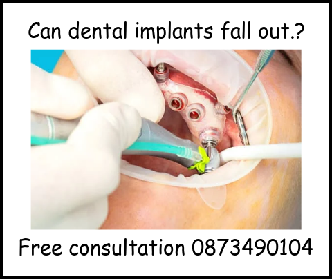 Can dental implants fall out image