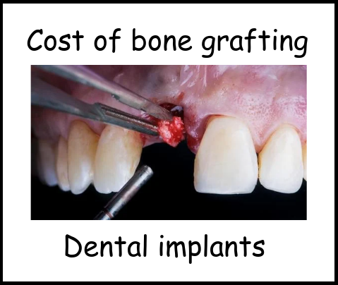 Cost of bone grafting dental implants image 