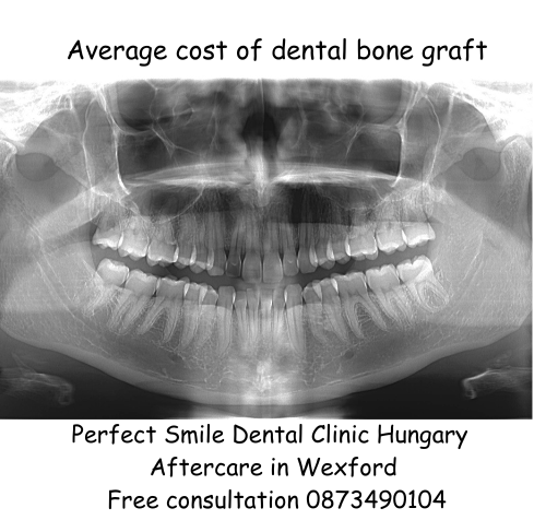 Average cost of dental bone graft image
