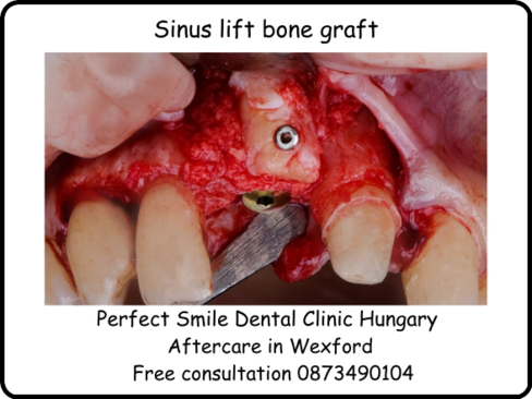 Sinus lift bone graft image