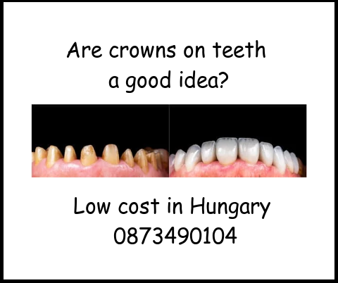 Are crowns on teeth a good idea image