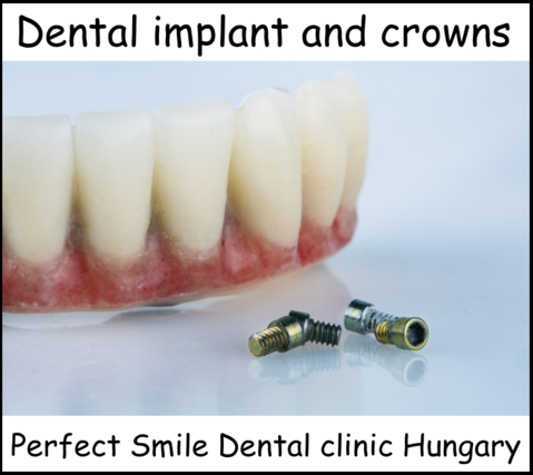 Dental implant and crowns image