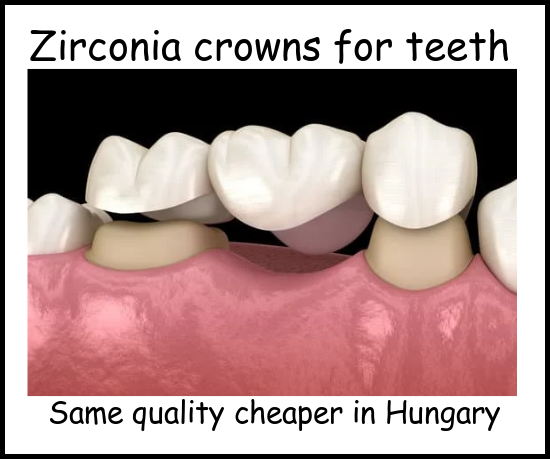 Zirconia crowns for teeth image