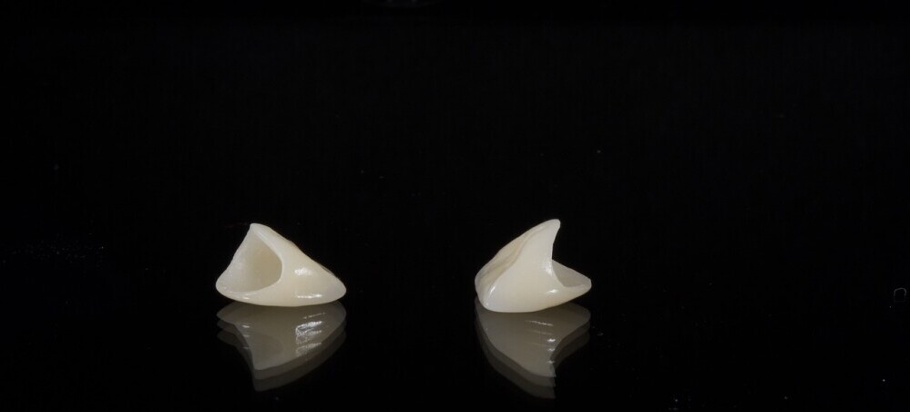 Emax dental crowns image