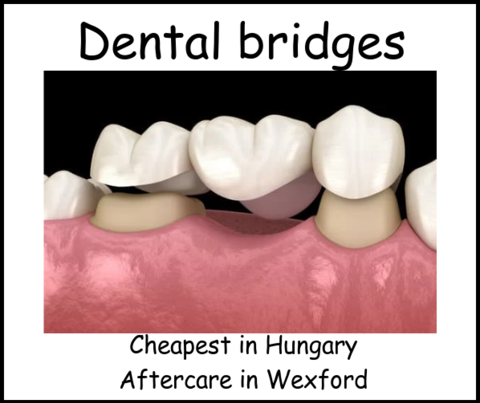 Dental bridges image