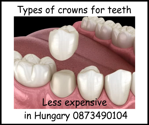 Types of crowns image