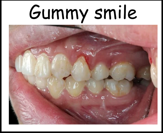 Gummy Smile image