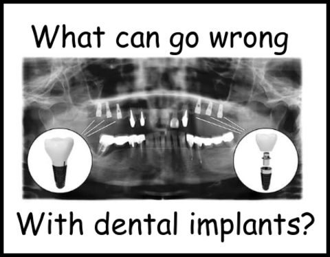 What can go wrong with dental implants image 1