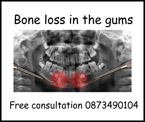 Bone loss in the gums image